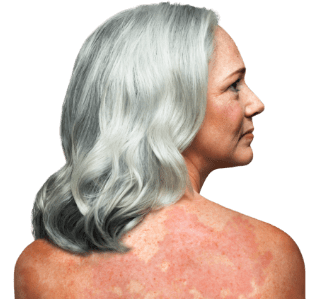 side effects of POTELIGEO in patients