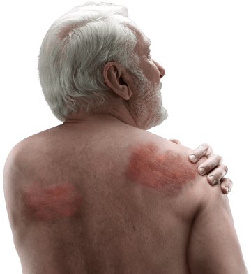 Representative image of a male patient with MF