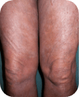 Exfoliative erythroderma in Sézary syndrome (SS) patient