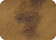mycosis fungoides (MF) cancerous t-cell skin patch