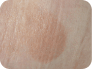 mycosis fungoides (MF) cancerous t-cell skin plaque