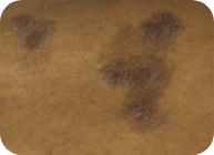 mycosis fungoides (MF) cancerous t-cell skin patch