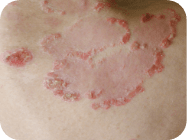 mycosis fungoides (MF) cancerous t-cell skin plaque