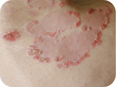 What is Mycosis Fungoides (MF)? | POTELIGEO® (mogamulizumab-kpkc)