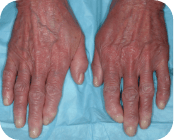 Waxy erythroderma in Sézary syndrome (SS)