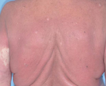 Image of erythroderma in SS