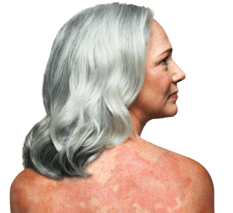 Representative image of Cutaneous T-cell lymphoma (CTCL) female cancer patient