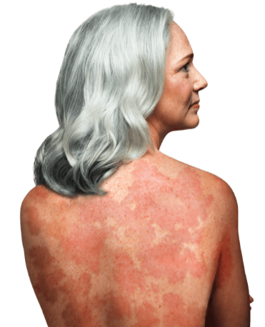 Treat mycosis fungoides (MF) and Sézary syndrome (SS), two types of cutaneous T-cell lymphoma (CTCL)