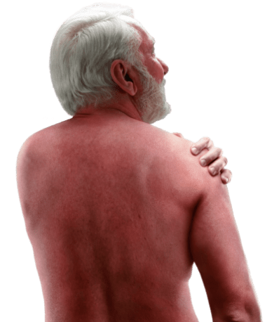 Treat mycosis fungoides (MF) and Sézary syndrome (SS), two types of cutaneous T-cell lymphoma (CTCL)