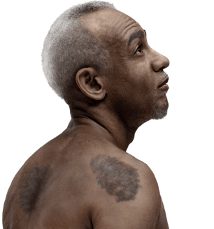 Representative image of a patient with mycosis fungoides (MF)