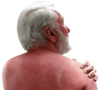 Representative image of Sézary syndrome (SS) patient